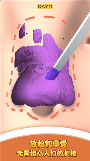 我爱挤黑头  v1.4