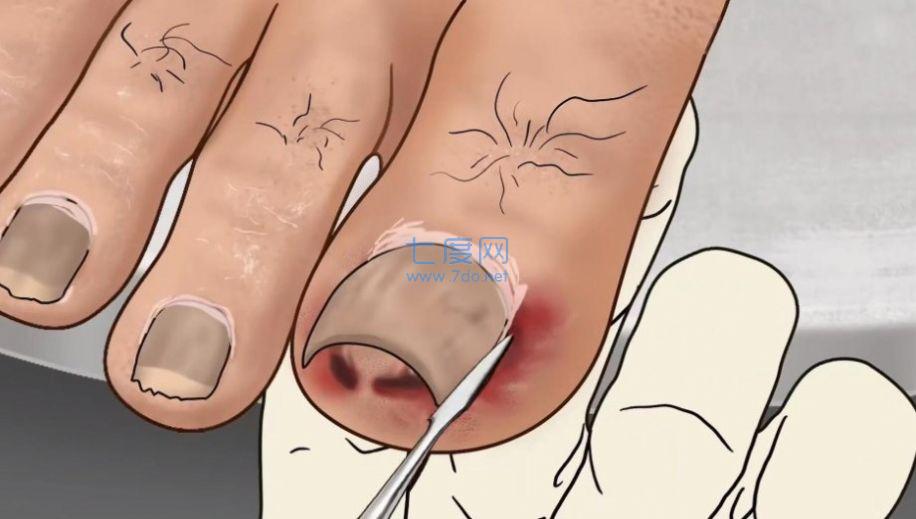 修脚足疔模拟器游戏